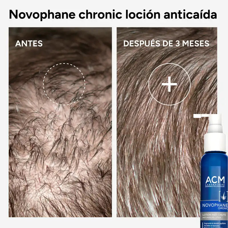 Acm Laboratoires Novophane Chronic Anti-Hair Loss Lotion, 100 ml