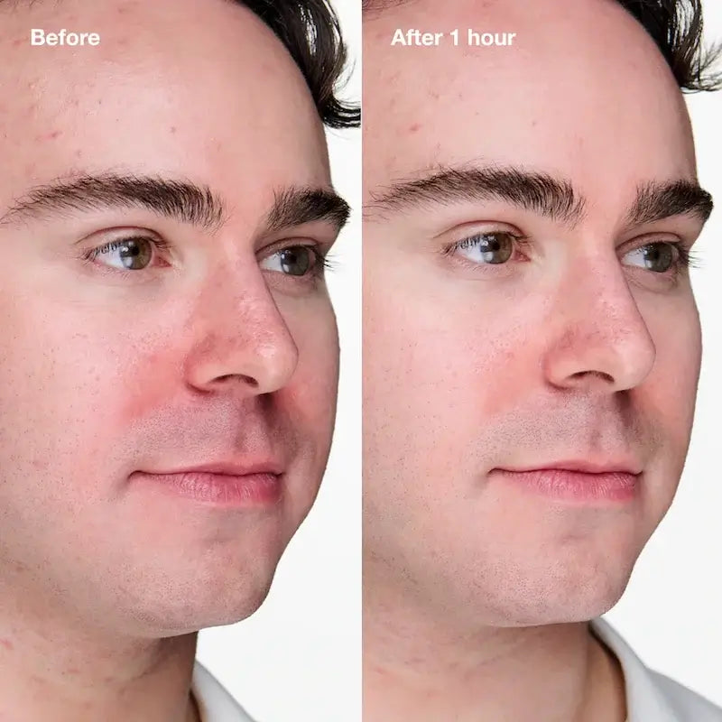 Clinique Anti-Blemish Solutions Clinical Advanced Cleansing Gel, 20 ml