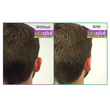 CORRETOR ESTÉTICO PARA ORELHAS OTOSTICK PELE NORMAL