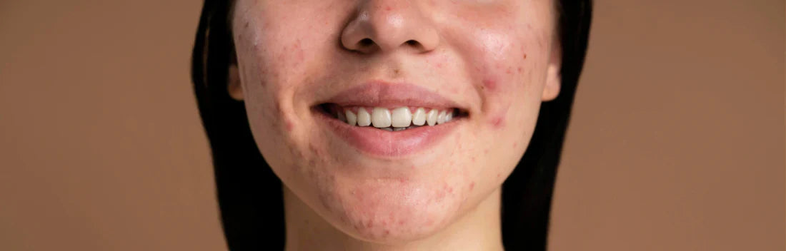 Acne adulta: por que aparece e como tratá-la de forma eficaz