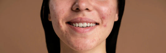 Acne adulta: por que aparece e como tratá-la de forma eficaz