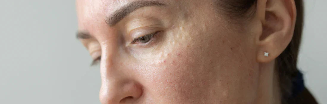 Barreira cutânea danificada: como recuperá-la com cuidados adequados e uma rotina reparadora