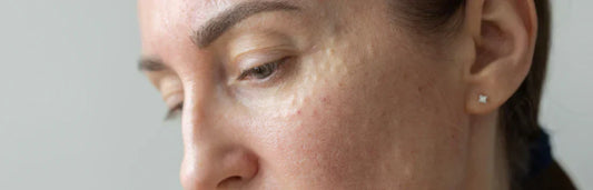 Barreira cutânea danificada: como recuperá-la com cuidados adequados e uma rotina reparadora