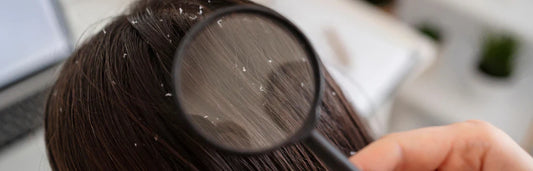 Diferenças entre caspa seca ou oleosa