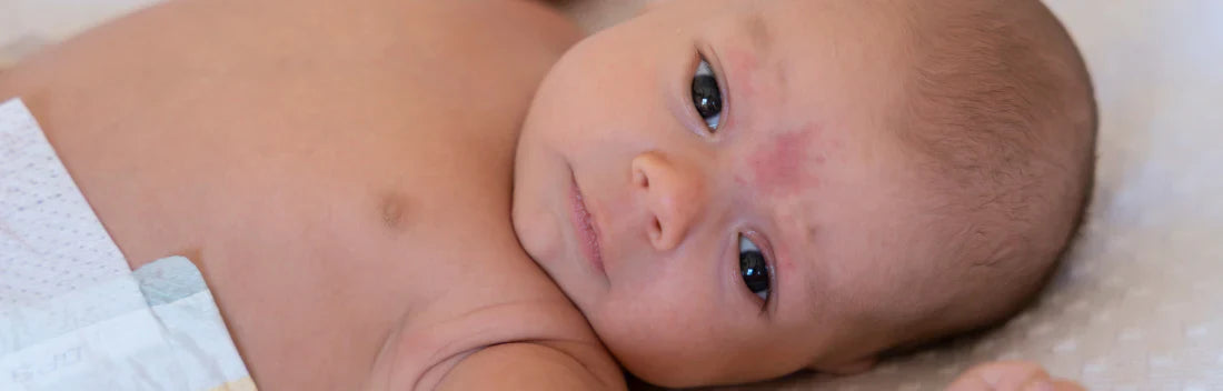 Picadas de mosquito em bebés Como tratar e prevenir?