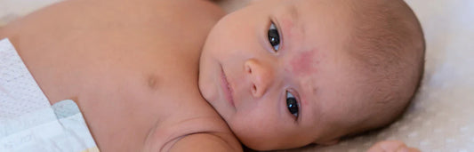 Picadas de mosquito em bebés Como tratar e prevenir?