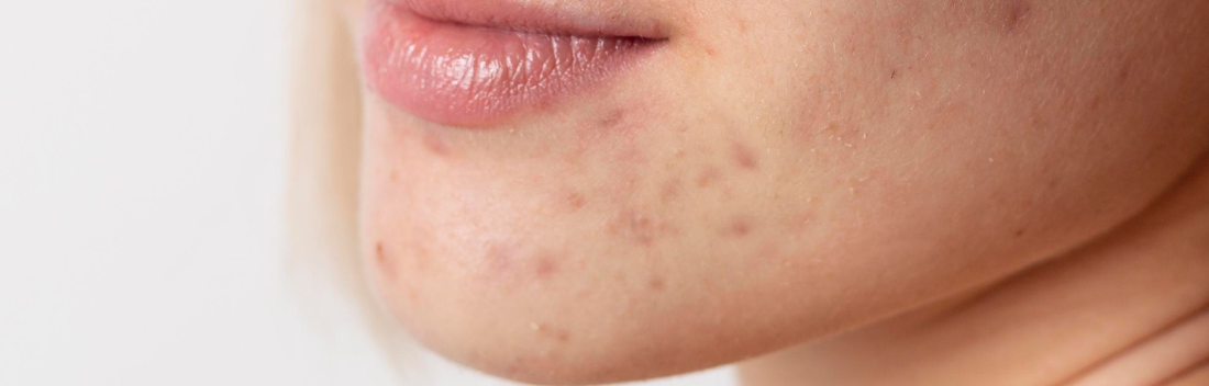 Como remover marcas de acne