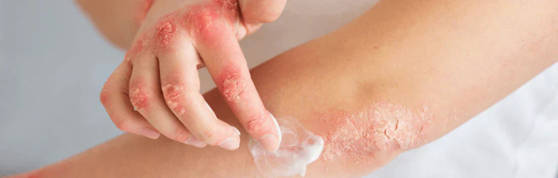 Eczema ou psoríase: diferenças e tratamento
