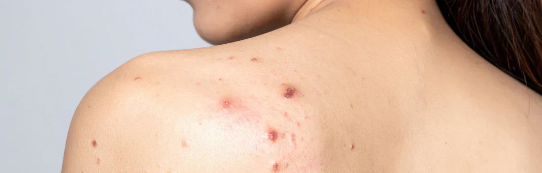 Grãos nas costas: causas e tratamento para melhorar a pele do corpo