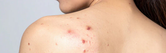 Grãos nas costas: causas e tratamento para melhorar a pele do corpo