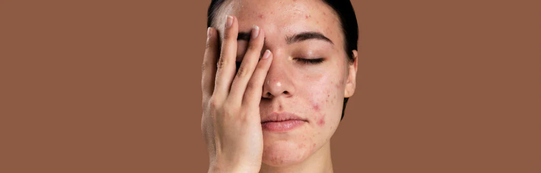 Borbulhas causadas pelo calor: por que surgem surtos de acne no verão e como preveni-los