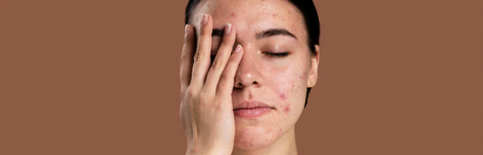 Borbulhas causadas pelo calor: por que surgem surtos de acne no verão e como preveni-los