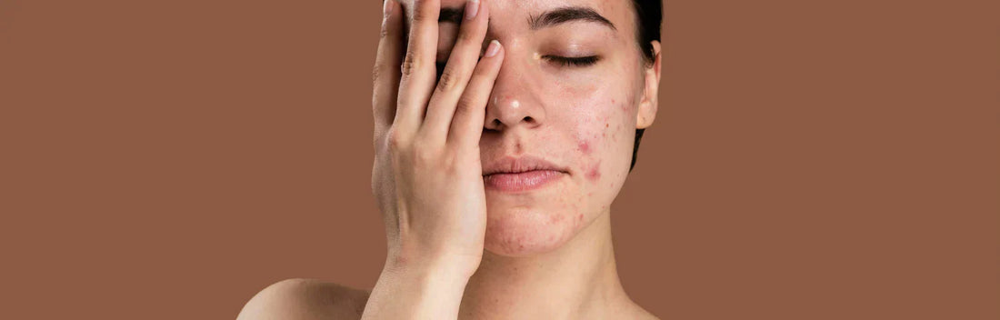 Ingredientes naturais mais eficazes para combater a acne e melhorar a saúde da pele