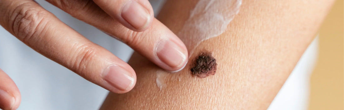 Melanoma: causas, sintomas e como preveni-los
