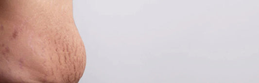 Estrias vermelhas, como as eliminar?