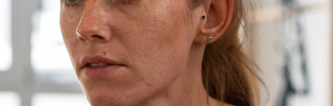 O melhor tratamento antimanchas para depois do verão