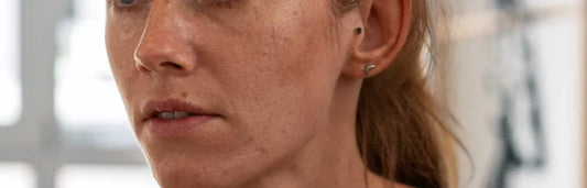 O melhor tratamento antimanchas para depois do verão