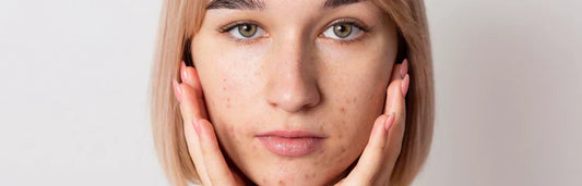 Cuidados faciais para pele oleosa: como reduzir acne e cravos com uma rotina eficaz