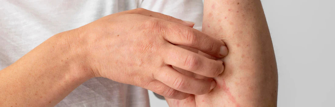 Urticária na pele: tipos e os melhores cremes anti-histamínicos de farmácia