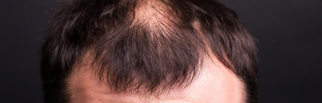 Alopecia areata: causas, sintomas e tratamento a seguir