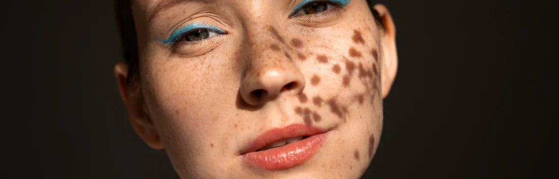 A rotina de despigmentação perfeita para o verão