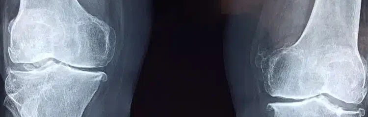 Por que as nossas articulações doem e como combater a dor de forma eficaz