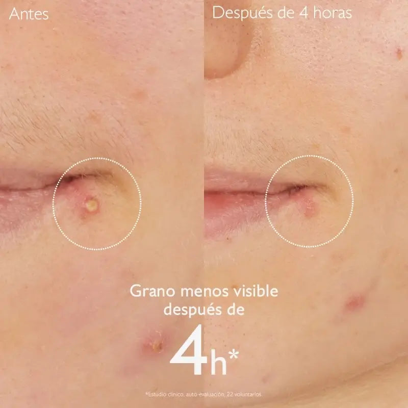 Caudalie Vinopure Tratamento anti-espinhas com ácido salicílico, 15ml