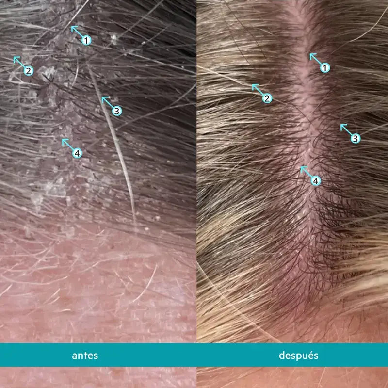 Ds Laboratories Dandrene Champô Esfoliante Anti-Caspa, 205ml