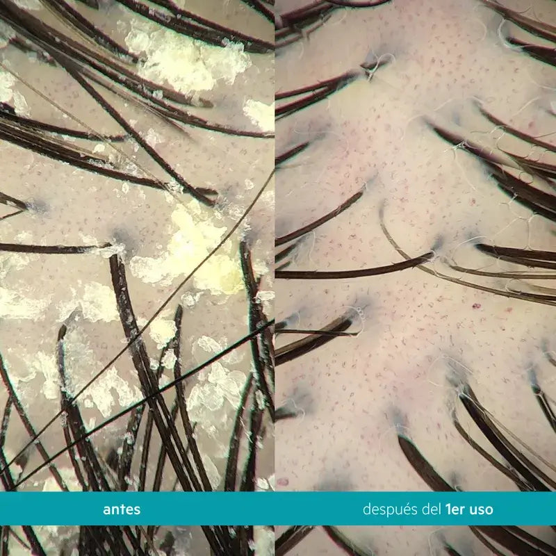 Ds Laboratories Dandrene Champô Esfoliante Anti-Caspa, 205ml