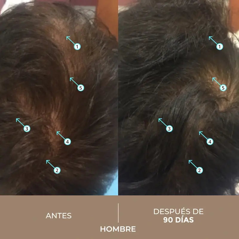 Ds Laboratories Spectral Lotion Dnc-N 3 Meses Tratamento com Nanoxidil® 5% Queda de Cabelo, 180 ml