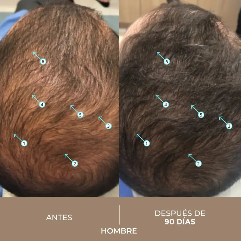 Ds Laboratories Spectral Lotion Dnc-N 3 Meses Tratamento com Nanoxidil® 5% Queda de Cabelo, 180 ml