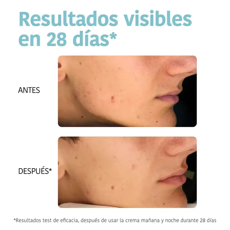 Iroha Nature Pele Oleosa Creme Seboregulador Anti-imperfeições , 50 ml