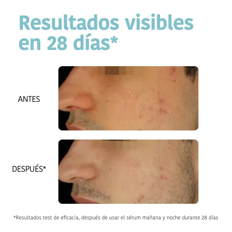 Iroha Nature Soro Anti-Imperfeições para Pele Oleosa, 30 ml