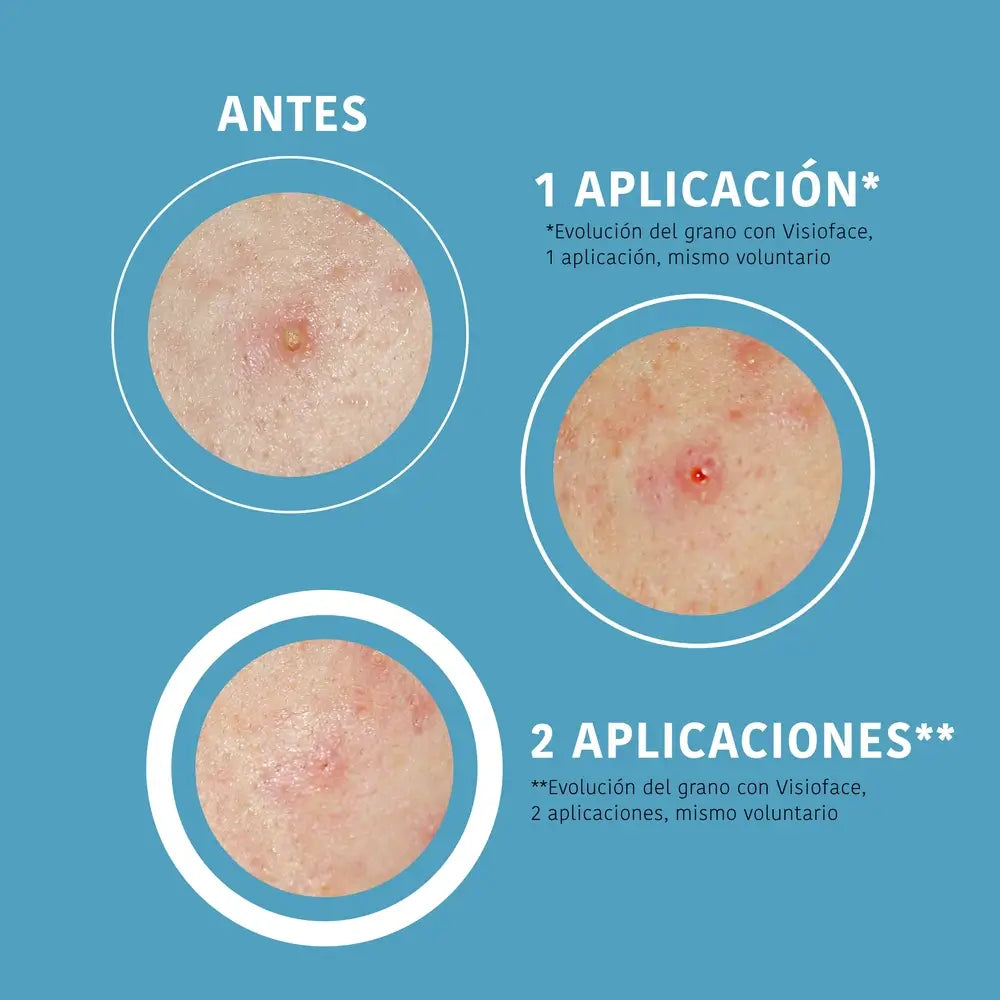 Iroha Nature Sos Patches para Espinhas - Ácido Salicílico, 18 unid.