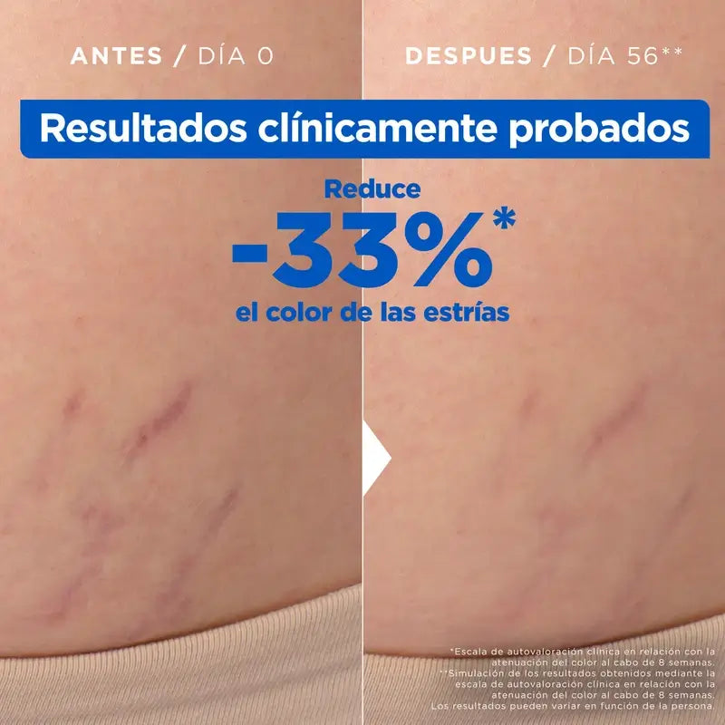 Mixa Óleo Anti-Estrias, 100 ml